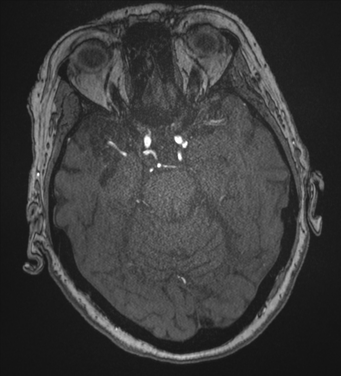 Bilateral fetal posterior communicating arteries (Radiopaedia 41286-44102 Axial MRA 71).png