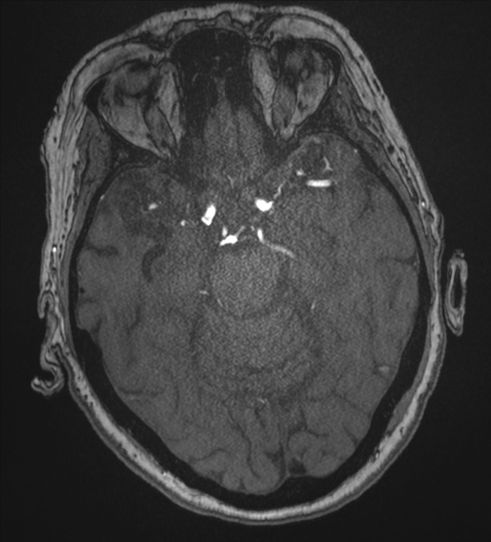 Bilateral fetal posterior communicating arteries (Radiopaedia 41286-44102 Axial MRA 75).png