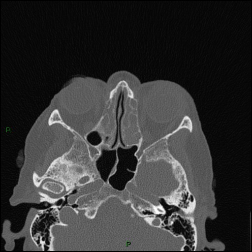 File:Bilateral frontal mucoceles (Radiopaedia 82352-96454 Axial bone window 154).jpg