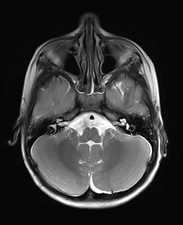 File:Bilateral mesial temporal polymicrogyria (Radiopaedia 76456-88181 Axial T2 5).jpg