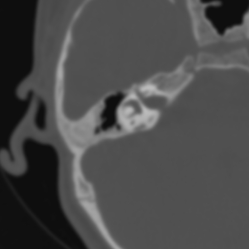 File:Bilateral otosclerosis (Radiopaedia 57237-64157 B 66).jpg