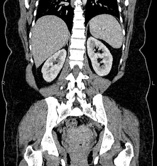 Bilateral ovarian dermoid cysts (Radiopaedia 85785-101603 C 41).jpg