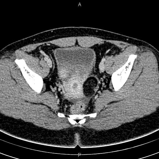 Bilateral ovarian teratoma (Radiopaedia 83131-97503 B 48).jpg