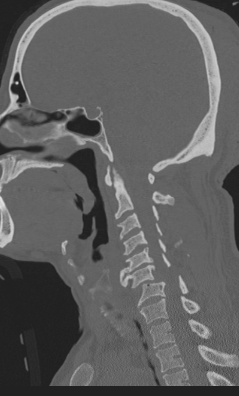 Bilateral perched facet joint (Radiopaedia 63149-71669 Sagittal bone window 24).jpg