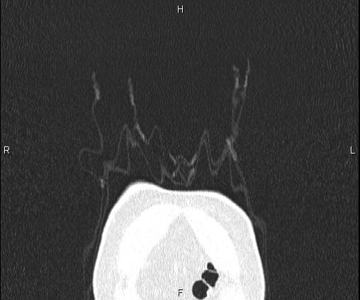 Bilateral pulmonary AVM (Radiopaedia 83134-97505 Coronal lung window 5).jpg