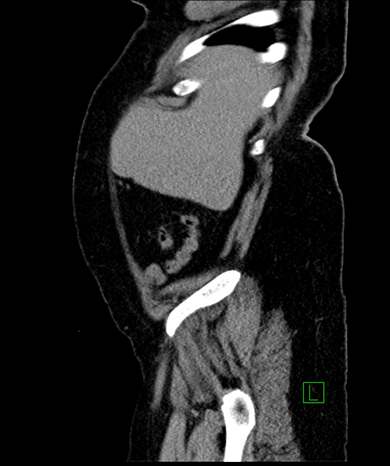 Bilateral sporadic synchronous clear cell renal cell carcinoma (Radiopaedia 85035-100575 E 106).jpg