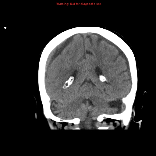 File:Bilateral subdural hemorrhage (Radiopaedia 8819-9620 Coronal non-contrast 14).jpg