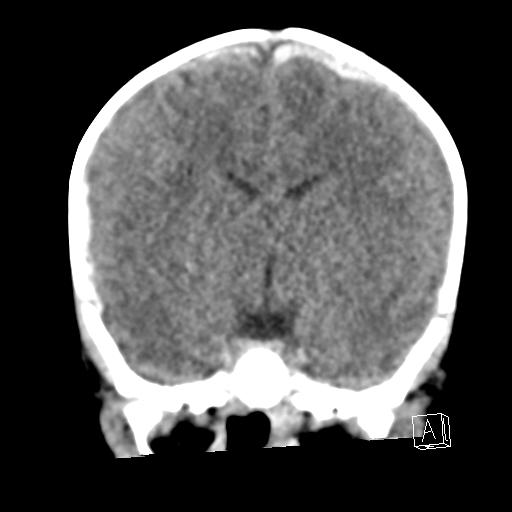 File:Bilateral subdural hemorrhage and parietal skull fracture (Radiopaedia 26058-26192 Coronal non-contrast 13).png