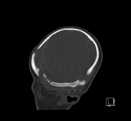 Bilateral subdural hemorrhage and parietal skull fracture (Radiopaedia 26058-26192 Sagittal bone window 11).png