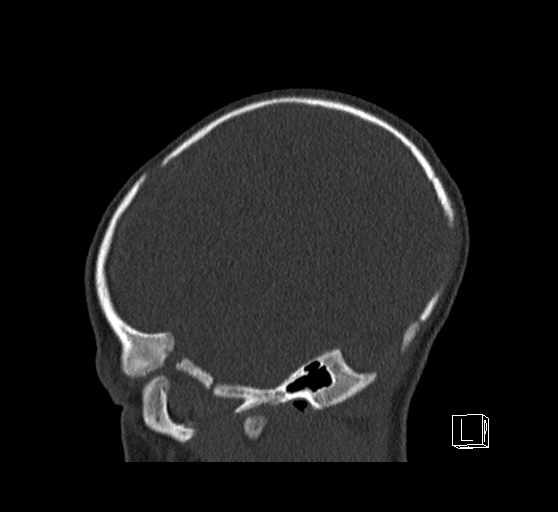 Bilateral subdural hemorrhage and parietal skull fracture (Radiopaedia 26058-26192 Sagittal bone window 18).png