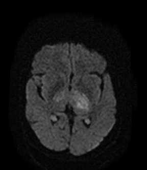 File:Bilateral thalamic glioma (Radiopaedia 65852-75009 Axial DWI 10).jpg