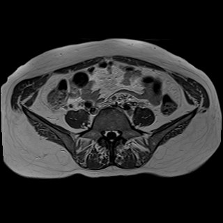 Bilateral tubo-ovarian abscesses (Radiopaedia 58635-65829 Axial T1 C+ 2).jpg