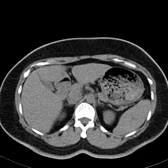File:Bilateral ureteric stents (Radiopaedia 48795-53825 Axial non-contrast 14).jpg
