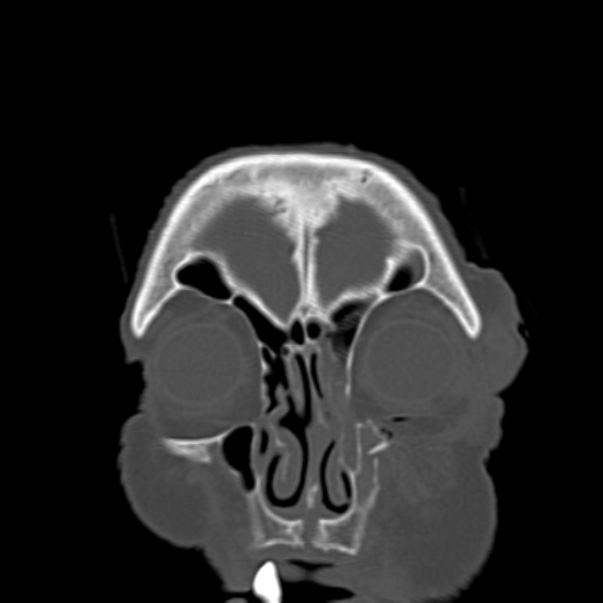 Biparietal osteodystrophy (Radiopaedia 46109-50463 Coronal bone window 20).jpg