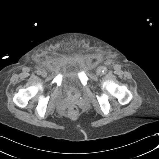 File:Bladder rupture post renal biopsy (Radiopaedia 30863-31572 Axial non-contrast 86).jpg