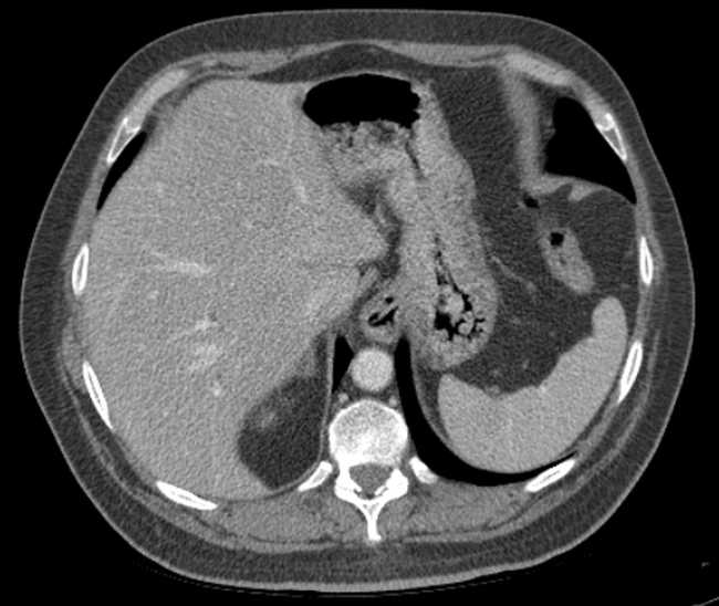 Bleeding duodenal ulcer and adenomyomatosis of gallbladder (Radiopaedia 61834-69861 A 21).jpg