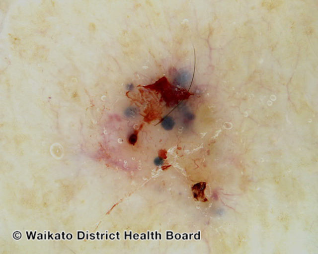 File:Blue-grey ovoid nests in pigmented basal cell carcinoma dermoscopy (DermNet NZ bcc-arm-2-wdhb).jpg