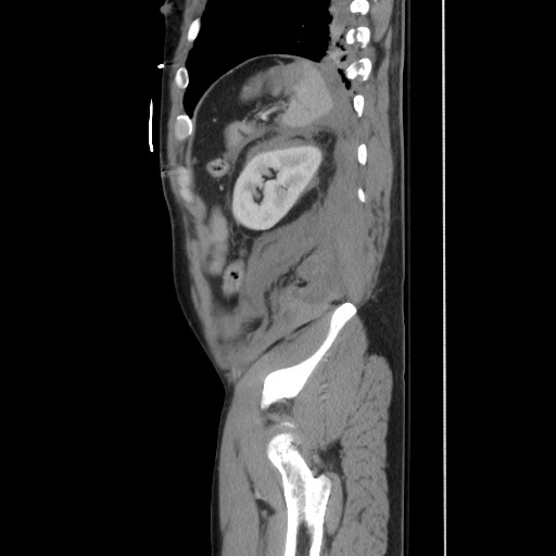 File:Blunt abdominal trauma with solid organ and musculoskelatal injury with active extravasation (Radiopaedia 68364-77895 C 116).jpg