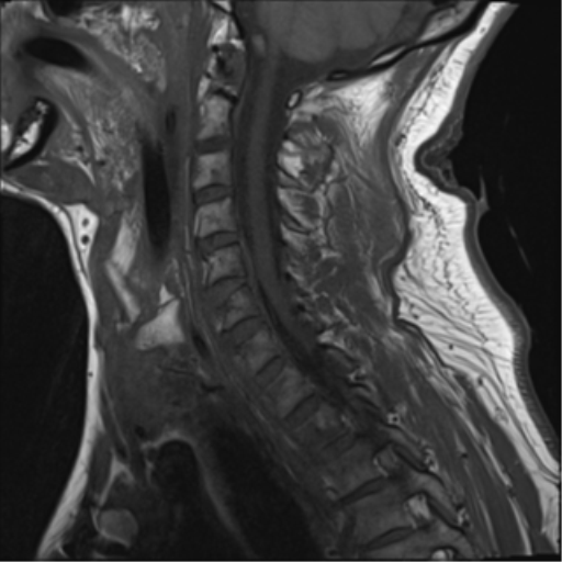 File:Blunt cerebrovascular injury (Radiopaedia 53682-59744 Sagittal T1 10).png