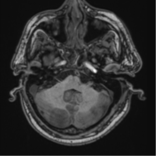 File:Blunt cerebrovascular injury (Radiopaedia 53682-59745 Axial T1 8).png