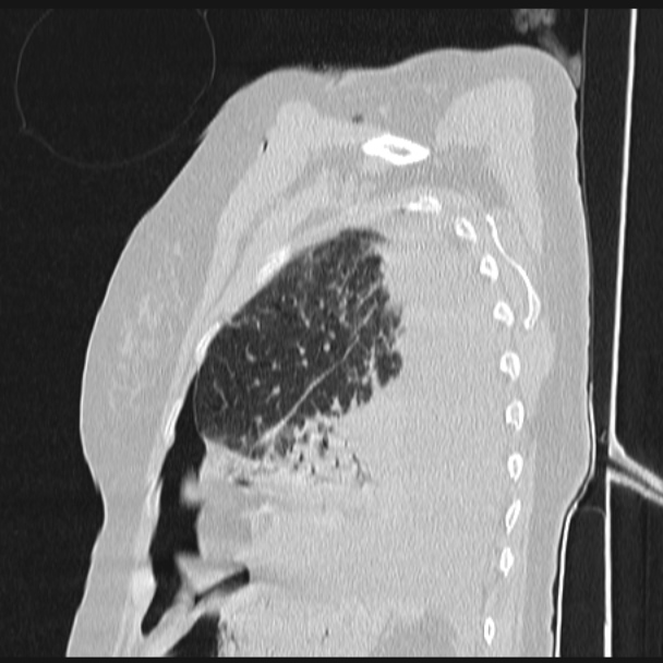 Boerhaave syndrome (Radiopaedia 45644-49799 Sagittal lung window 68).jpg