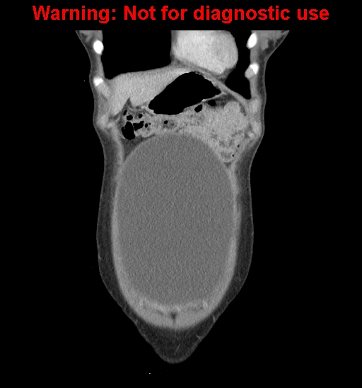 Borderline mucinous cystadenoma of ovary (Radiopaedia 25586-25767 B 7).jpg