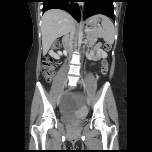 Borderline mucinous tumor (ovary) (Radiopaedia 78228-90808 C 30).jpg