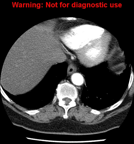 File:Bosniak renal cyst - type II (Radiopaedia 23404-23468 B 4).jpg
