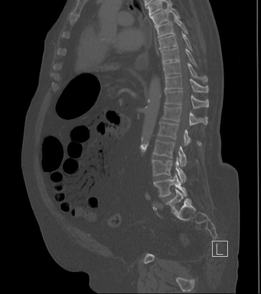 Bowel ischemia secondary to SMA occlusion with extensive portomesenteric venous gas (Radiopaedia 54656-60871 Sagittal bone window 49).jpg