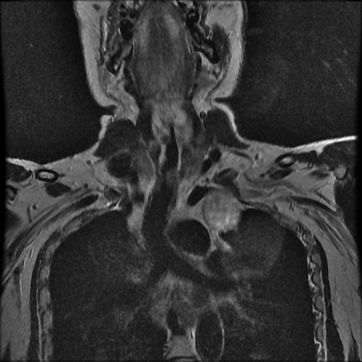 File:Brachial plexus neurofibroma (Radiopaedia 28030-28291 Coronal T2 10).png