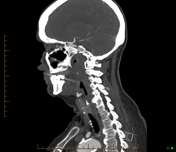 Brachiocephalic trunk stenosis (Radiopaedia 87242-103519 C 27).jpg