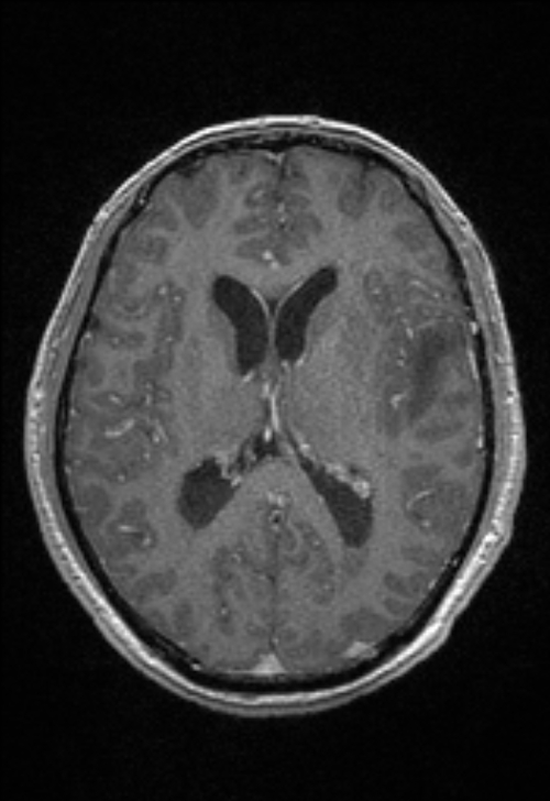 Brain abscess with ventriculitis (Radiopaedia 85703-101495 Axial T1 C+ 100).jpg