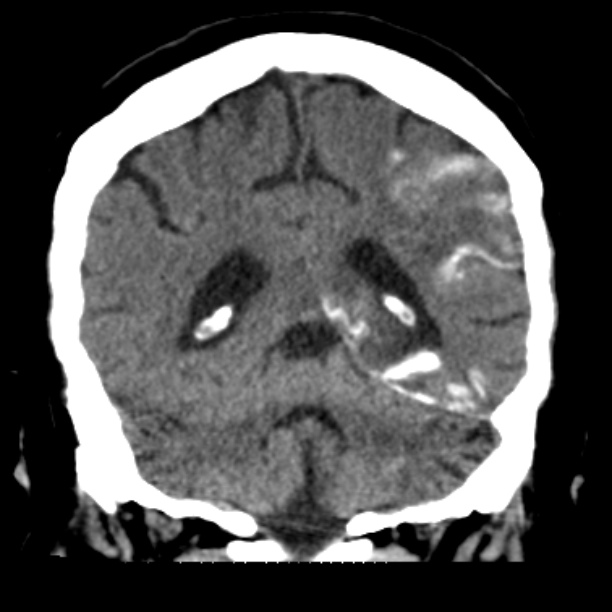 Brain cortical laminar necrosis (Radiopaedia 25822-25971 C 38).jpg