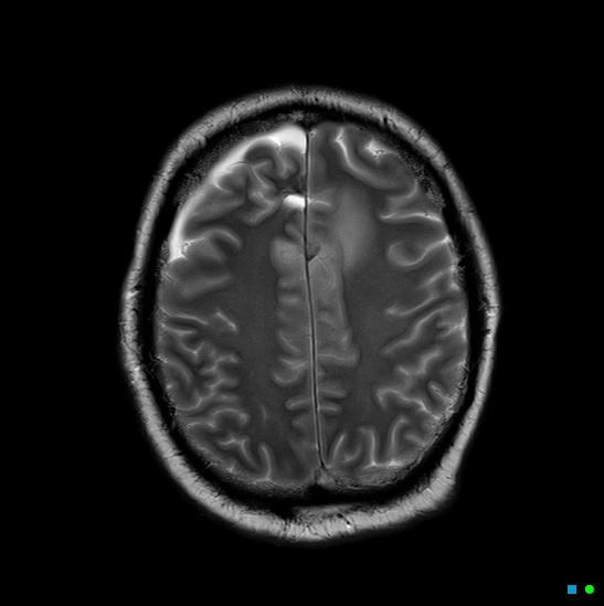 File:Brain death on MRI and CT angiography (Radiopaedia 42560-45689 Axial T2 24).jpg