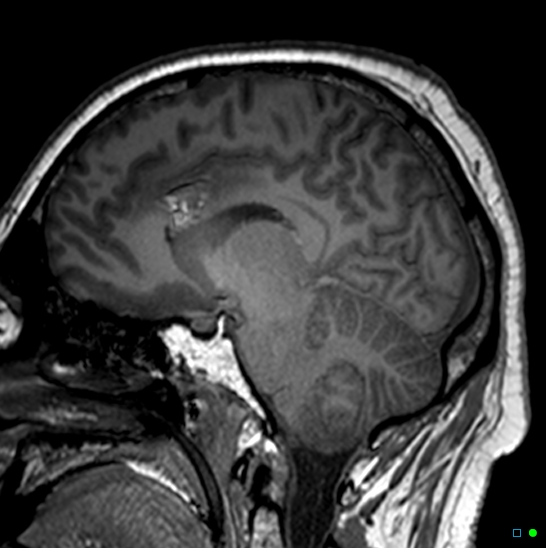 Brain death on MRI and CT angiography (Radiopaedia 42560-45689 Sagittal T1 17).jpg