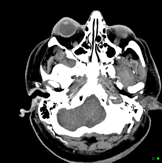 Brain death on MRI and CT angiography (Radiopaedia 42560-45841 B 44).jpg