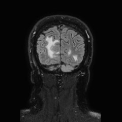 File:Brain metastases from lung cancer (Radiopaedia 83839-99028 Coronal FLAIR 74).jpg