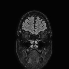 File:Brain metastases from lung cancer (Radiopaedia 83839-99028 Coronal FLAIR 8).jpg