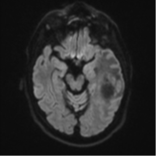 File:Brain metastasis (large cystic mass) (Radiopaedia 47497-52107 Axial DWI 38).png