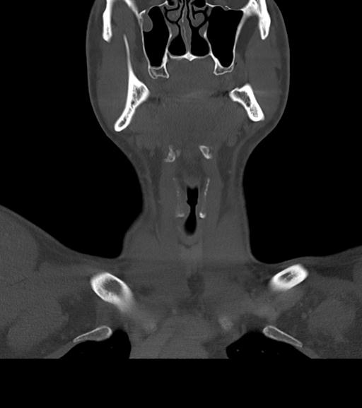 Branchial cleft cyst (Radiopaedia 31167-31875 Coronal bone window 24).jpg