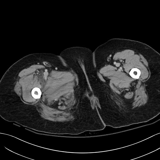 Breast carcinoma with pathological hip fracture (Radiopaedia 60314-67974 B 83).jpg