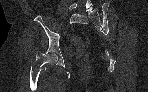 Breast carcinoma with pathological hip fracture (Radiopaedia 60314-67993 Coronal bone window 77).jpg
