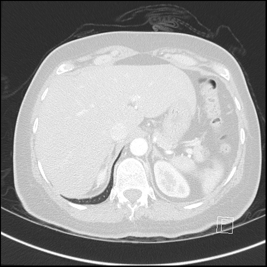 Breast metastases from renal cell cancer (Radiopaedia 79220-92225 Axial lung window 80).jpg