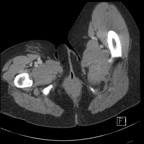 File:Breast metastases from renal cell cancer (Radiopaedia 79220-92225 C 136).jpg