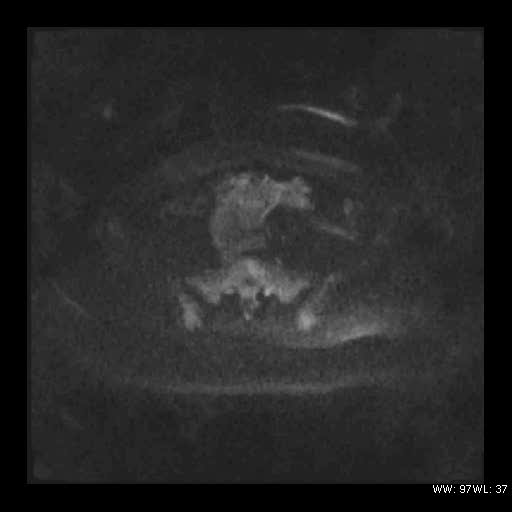 File:Broad ligament fibroid (Radiopaedia 49135-54241 Axial DWI 13).jpg