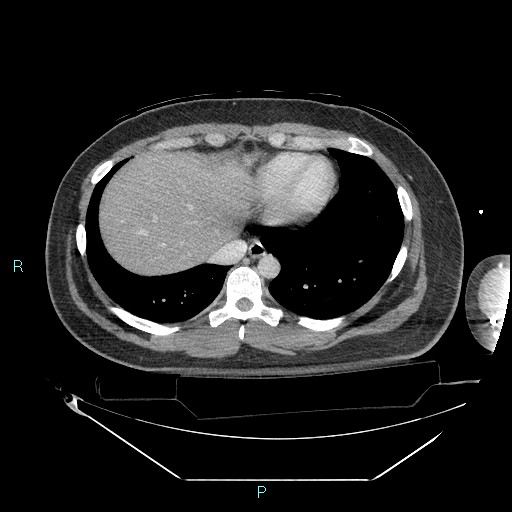 Bronchial carcinoid tumor (Radiopaedia 78272-90870 C 93).jpg