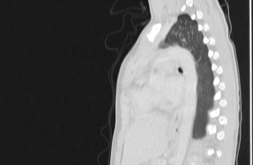 Bronchial mucoepidermoid carcinoma (Radiopaedia 57023-63895 Sagittal lung window 107).jpg