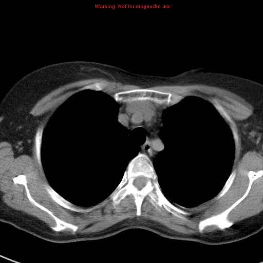 File:Bronchoalveolar carcinoma (BAC) (Radiopaedia 13436-13392 Axial non-contrast 12).jpg