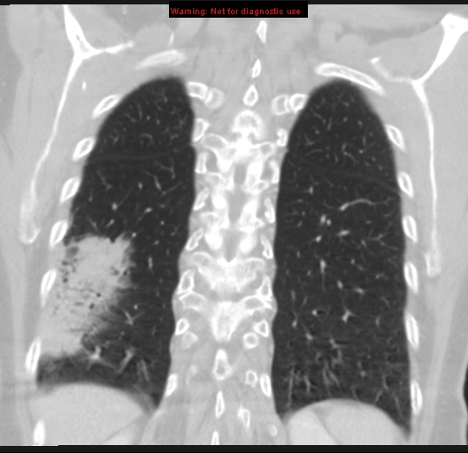 Bronchoalveolar carcinoma (BAC) (Radiopaedia 13436-13392 Coronal lung window 48).jpg