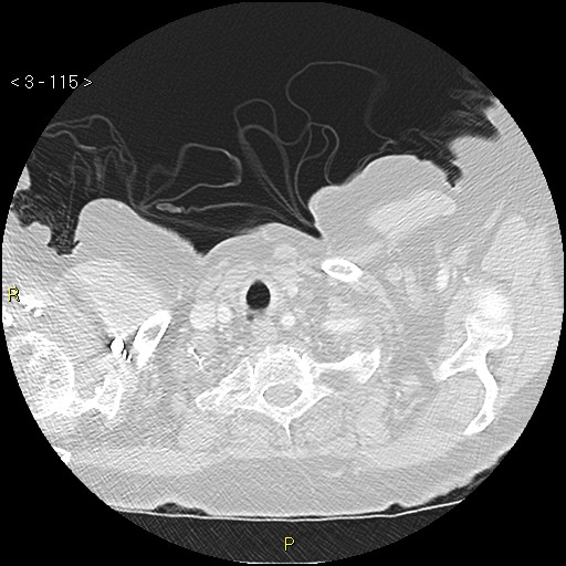 Bronchogenic carcinoma as an incidental finding (Radiopaedia 16453-16130 Axial lung window 115).jpg
